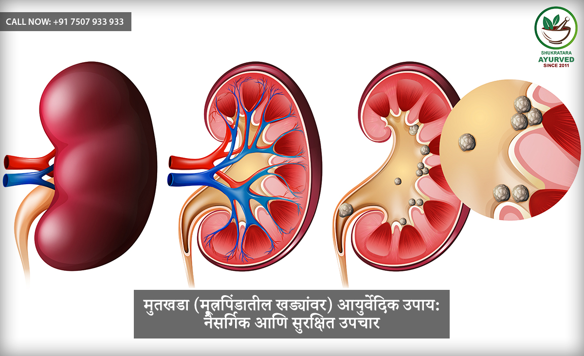 मुतखडा (मूत्रपिंडातील खड्यांवर) आयुर्वेदिक उपाय: नैसर्गिक आणि सुरक्षित उपचार