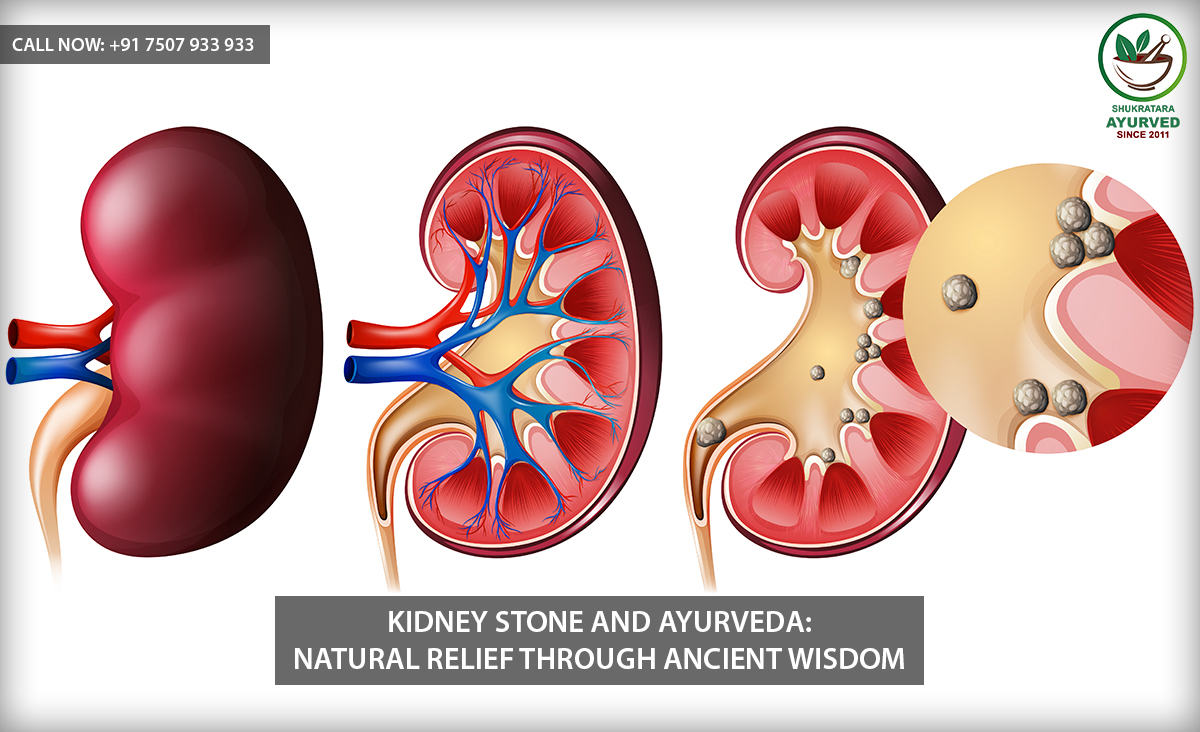 Kidney Stone and Ayurveda: Natural Relief through Ancient Wisdom